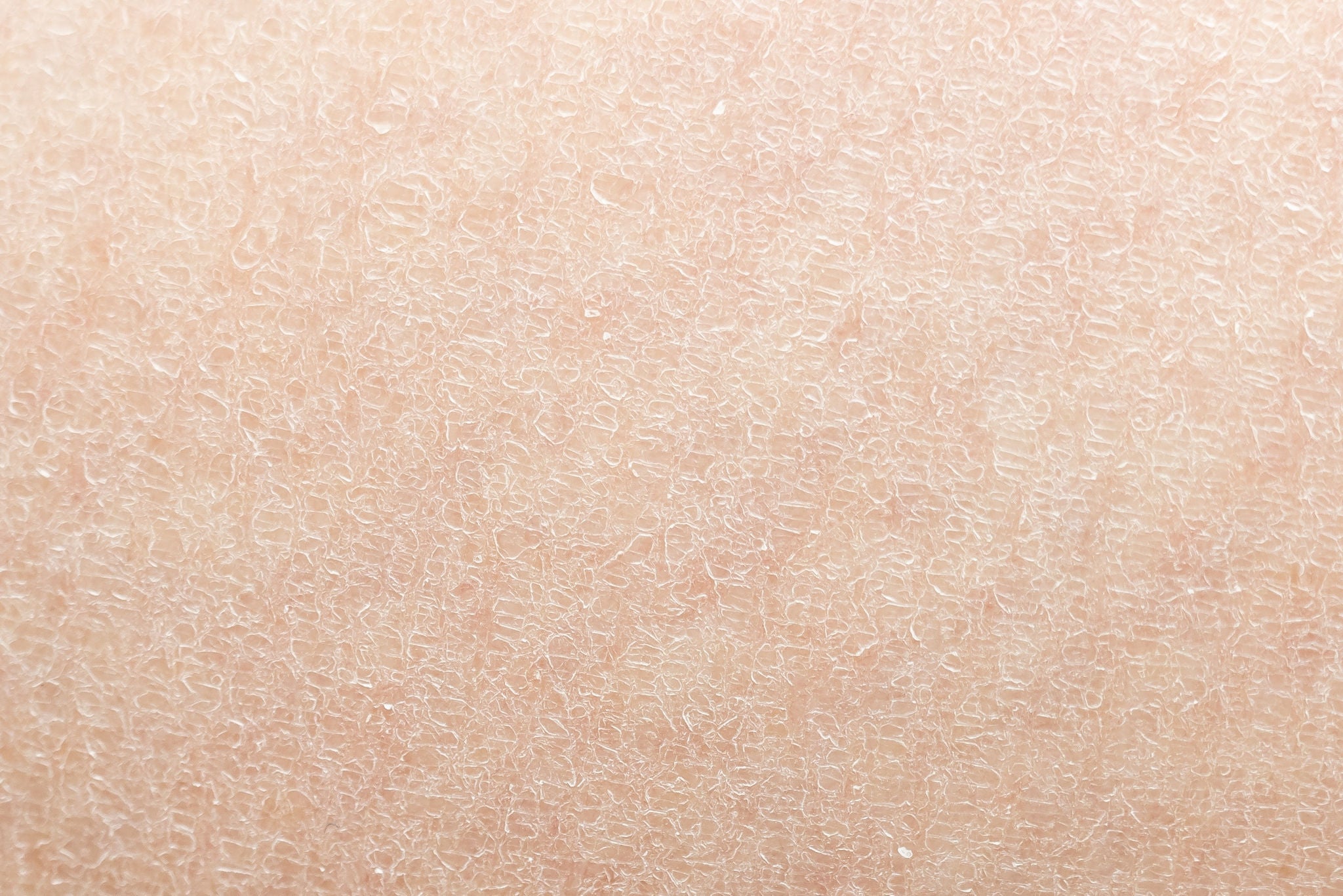 Cilt Kuruluğu Neden Olur? Cilt Kuruluğu Nasıl Geçer?-1