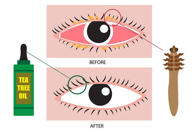 Göz kapağı Demodex akarı ve çay ağacı yağı tedavisi öncesi sonrası illüstrasyonu